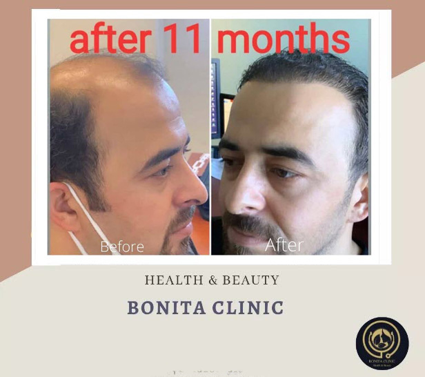 Hair-services-clinicbonita (1) بهترین مرکز کاشت مو | کلینیک بنیتا