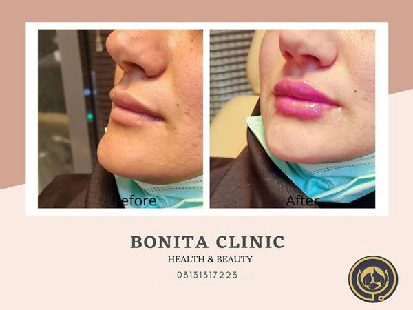 skin-services-clinicbonita (1) تزریق فیلر لب توسط پزشک باتجربه