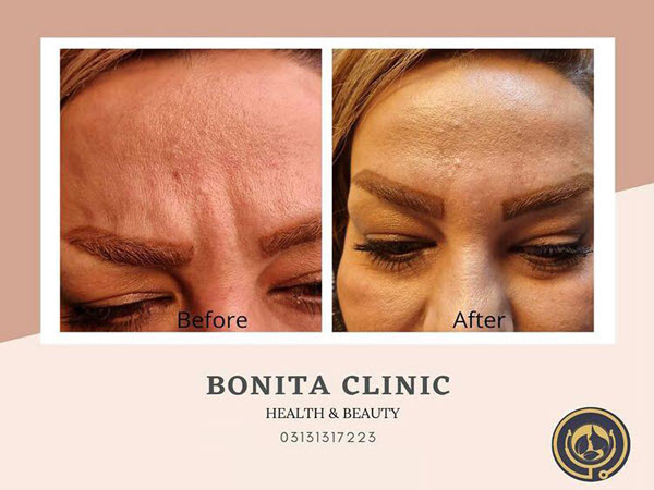 skin-services-clinicbonita (3) تزریق بوتاکس با قیمت مناسب | بنیتا اصفهان