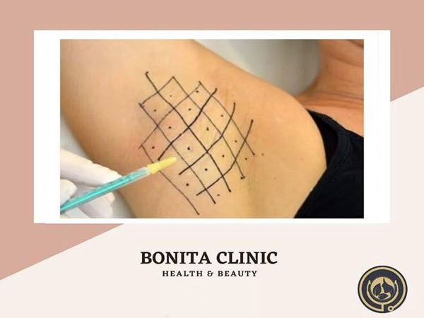 skin-services-clinicbonita (6) تزریق بوتاکس زیر بغل | کلینیک بنیتا اصفهان