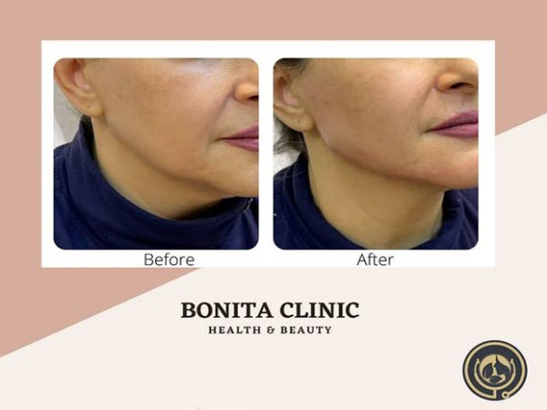 skin-services-clinicbonita (8) تزریق فیلر با بهترین قیمت | کلینیک بنیتا
