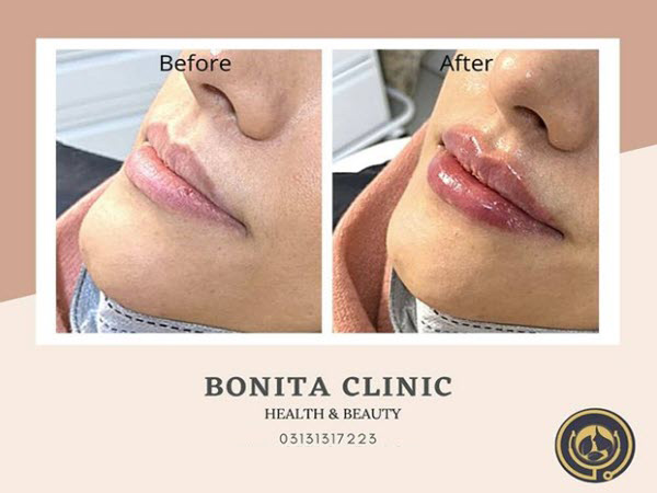 skin-services-clinicbonita (9) تزریق ژل لب توسط پزشک باتجربه | کلینیک بنیتا