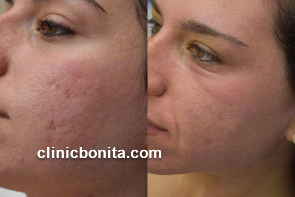 آر اف فرکشنال | کلینیک بنیتای اصفهان