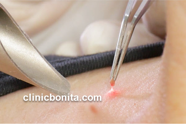 برداشتن خال و زگیل | کلینیک بنیتای اصفهان