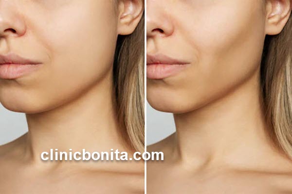 تخلیه بوکال فت | کلینیک بنیتای اصفهان