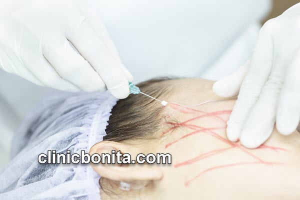 لیفت صورت با نخ | کلینیک بنیتای اصفهان