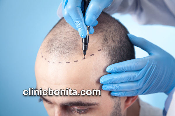 کاشت مو | کلینیک بنیتای اصفهان