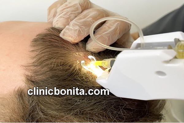 مزوتراپی مو | کلینیک بنیتای اصفهان