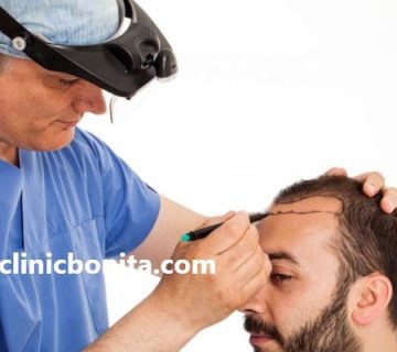 بهترین مرکز کاشت مو در اصفهان | کلینیک بنیتای اصفهان