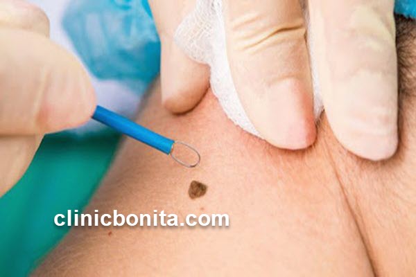 برداشتن خال و زگیل | کلینیک بنیتای اصفهان