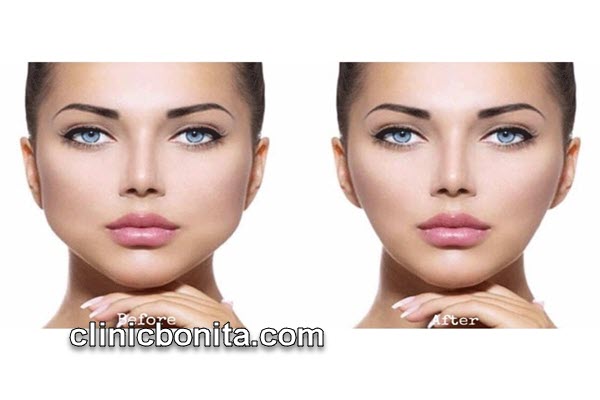 تخلیه بوکال فت | کلینیک بنیتای اصفهان