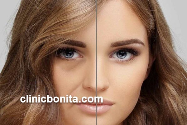 تزریق چربی | کلینیک بنیتای اصفهان