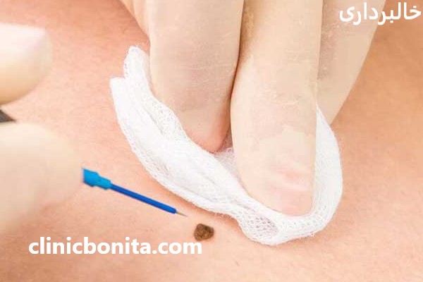 خالبرداری در بهترین کلینیک اصفهان - کلینیک بنیتای اصفهان