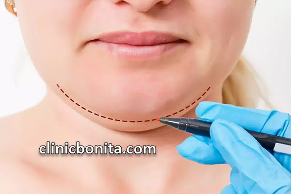 ساکشن غبغب | کلینیک بنیتای اصفهان