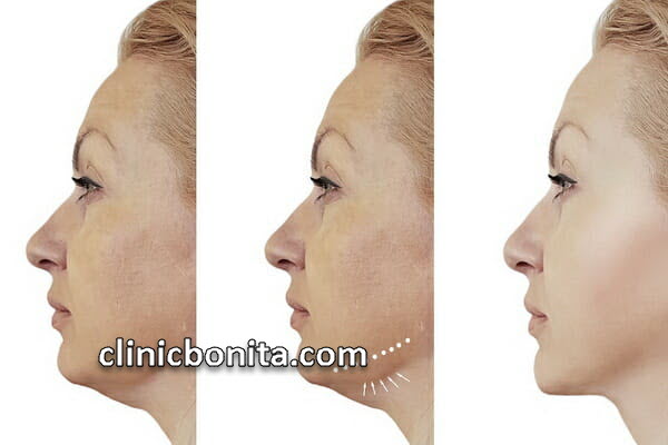 ساکشن غبغب | کلینیک بنیتای اصفهان