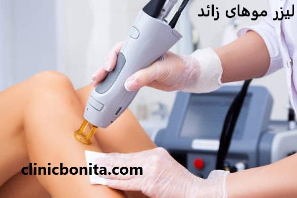 لیزر موهای زائد با تخفیف ویژه در کلینیک بنیتای اصفهان