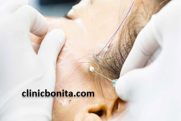 لیفت شقیقه با نخ | کلینیک بنیتای اصفهان