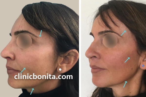 لیفت شقیقه با نخ | کلینیک بنیتای اصفهان