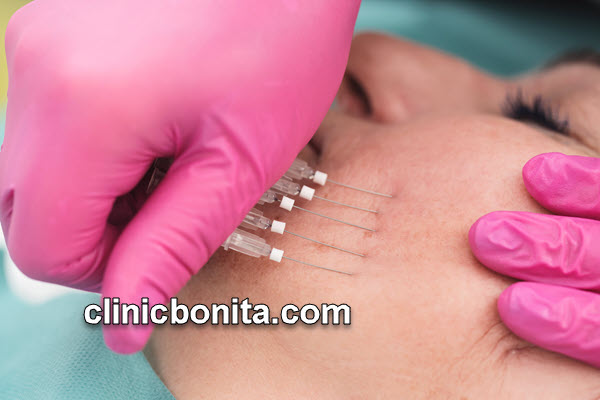 لیفت صورت با نخ | کلینیک بنیتای اصفهان