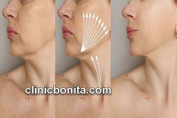 لیفت غبغب با نخ | کلینیک بنیتای اصفهان