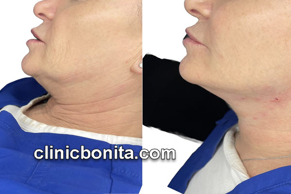 لیفت غبغب با نخ | کلینیک بنیتای اصفهان