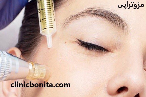 مزوتراپی با تخفیف ویژه در کلینیک بنیتای اصفهان