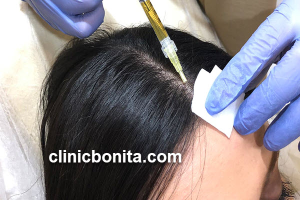 پی آر پی مو (PRP) | کلینیک بنیتای اصفهان