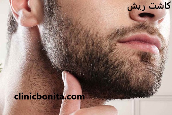 کاشت ریش با بهترین قیمت در اصفهان - کلینیک بنیتای اصفهان