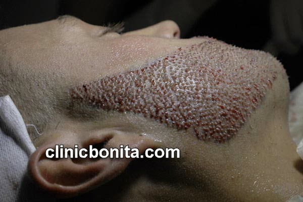 کاشت ریش | کلینیک بنیتا اصفهان