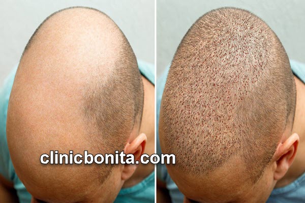 کاشت مو | کلینیک بنیتای اصفهان