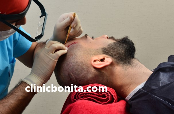 کاشت مو به روش FUT در اصفهان | کلینیک بنیتای اصفهان