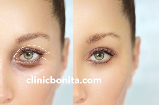 هزینه عمل جدید پلک در ایران | کلینیک بنیتای اصفهان