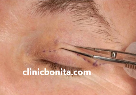 سریع ترین روش های مراقبتی بعد از بلفاروپلاستی | کلینیک بنیتای اصفهان