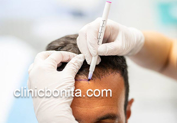 کاشت مو بدون جراحی با قیمت مناسب در اصفهان | کلینیک بنیتای اصفهان