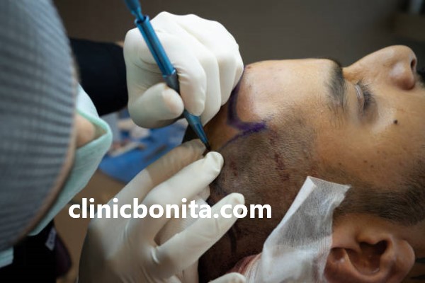 بهترین مرکز کاشت مو به روش superfue plus در اصفهان | کلینیک بنیتای اصفهان