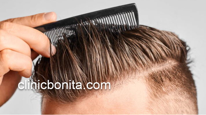 هزینه های کاشت مو بدون جراحی در اصفهان | کلینیک بنیتای اصفهان