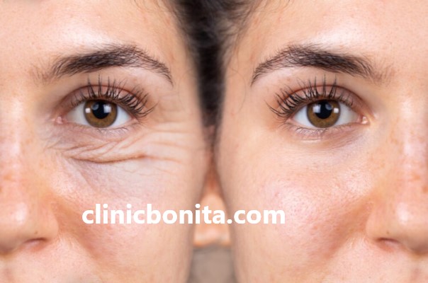 روش انجام بلفاروپلاستی پلک بالا | کلینیک بنیتای اصفهان