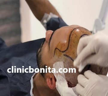 کلینیک تخصصی کاشت مو با تراکم بالا در اصفهان | کلینیک بنیتای اصفهان