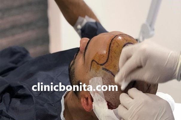 کلینیک تخصصی کاشت مو با تراکم بالا در اصفهان | کلینیک بنیتای اصفهان