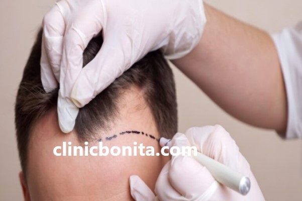 کاشت پر پشت مو در بهترین کلینیک اصفهان | کلینیک بنیتای اصفهان