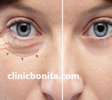 جدیدترین روش جراحی افتادگی پلک در ایران | کلینیک بنیتای اصفهان