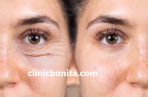 کشیده شدن چشم با عمل جراحی جدید دنیا | کلینیک بنیتای اصفهان