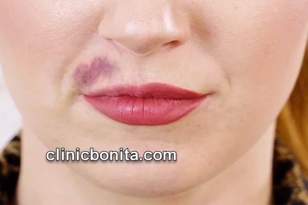 مراقبت های بعد از تزریق ژل خط خنده | کلینیک بنیتای اصفهان