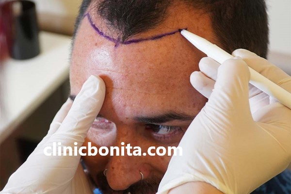 مراحل کاشت مو میکروگرافت در اصفهان | کلینیک بنیتای اصفهان