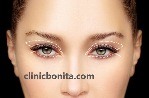 رفع افتادگی پلک توسط بهترین دکتر بلفاروپلاستی در ایران | کلینیک بنیتای اصفهان