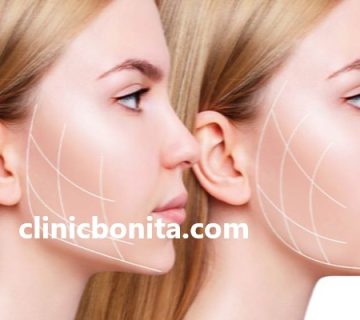 رفع غبغب و زاویه سازی فک با هایفوتراپی در اصفهان | کلینیک بنیتای اصفهان