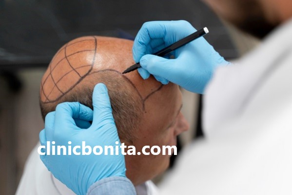 مرکز تخصصی کاشت مو به روش میکروگرافت در اصفهان | کلینیک بنیتای اصفهان