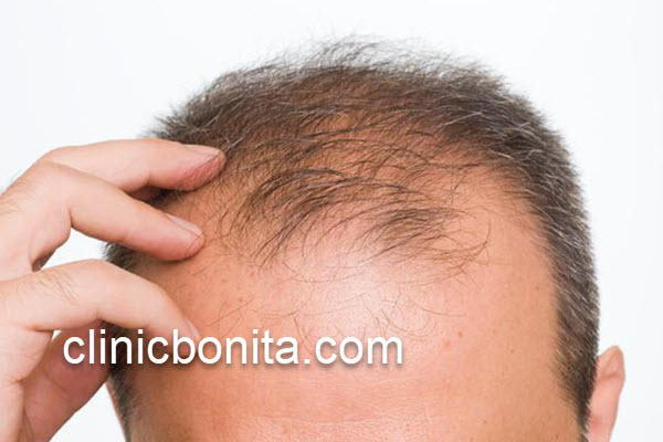 پیوند مو با روش های مختلف | کلینیک بنیتای اصفهان