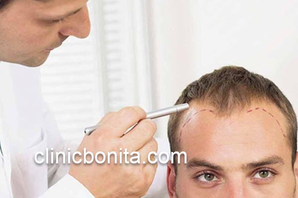 هزینه کاشت مو در سال 1402 | کلینیک بنیتای اصفهان