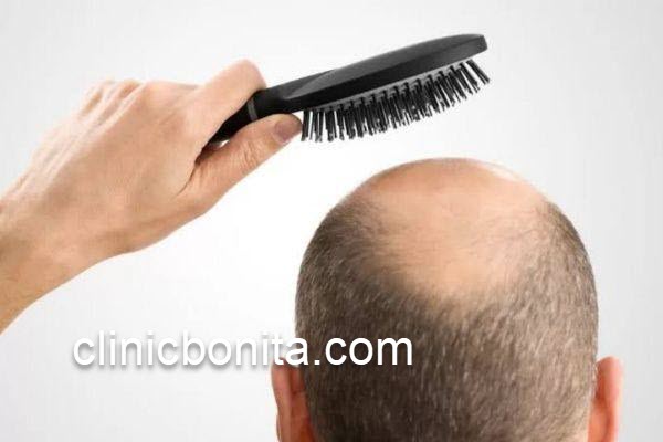 هزینه های کاشت مو در اصفهان | کلینیک بنیتای اصفهان